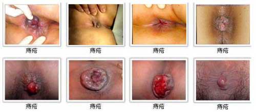 引起痔疮的因素是什么