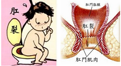 肛裂早发现症状需了解
