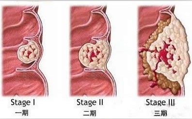女性患上痔疮怎么办