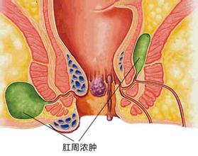 肛周脓肿怎么治疗